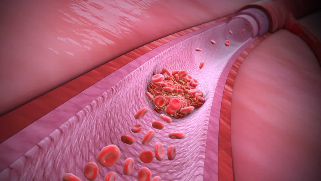 1655085037 Xet nghiem gen gay hoi chung tang dong Thrombophilia
